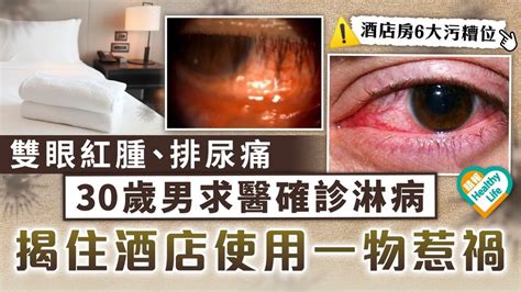 酒店衛生｜雙眼紅腫排尿痛 30歲男求醫確診淋病 揭住酒店使用一物惹禍 晴報 健康 其他疾病 D230804