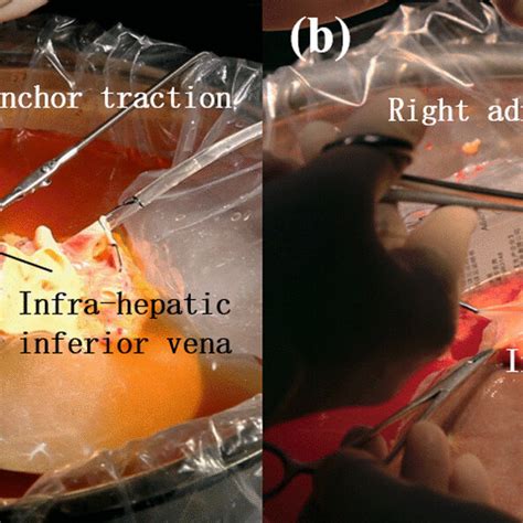 Supra Hepatic Inferior Vena Cava Trimming A Mat Group B Manual Group