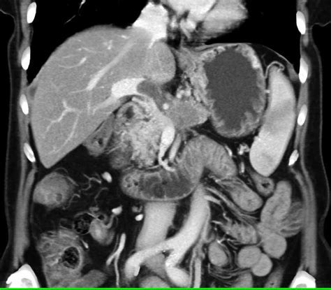 Pancreatic Cancer Invades The Portal Vein Splenic Vein And Superior