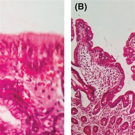 Endoscopic Biopsies Of Patient A Initial Biopsy Of Duodenal Mucosa