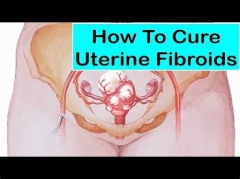 Large Uterine Fibroids Removed And Uterus Preserved Myomectomy