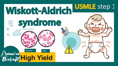 Wiskott Aldrich Syndrome WAS Immunology Of WAS Treatment And