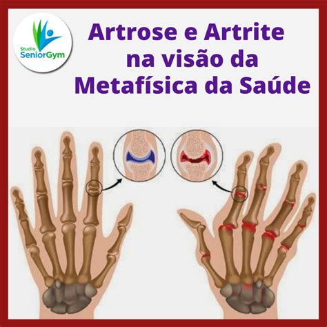 O Que Que É Artrose - O Que é Artrose Nos Pés - NAZAEDU