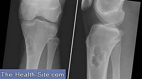fibroma penyebab bentuk pengobatan tumor jaringan ikat ilmiah