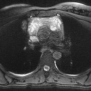 Thymoma Who Type B Image Radiopaedia Org