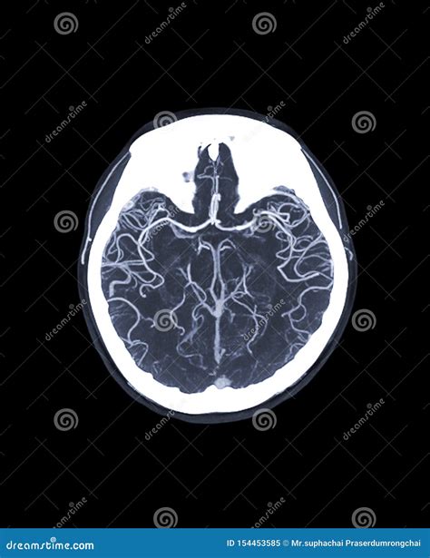 CTA Brain or CT Angiography of the Brain. Stock Image - Image of