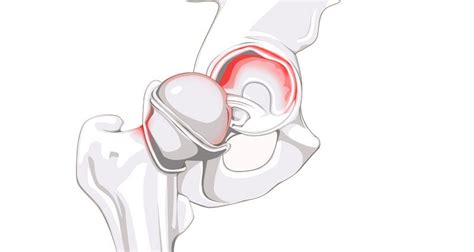 Labral Tear Hip Pain Symptoms