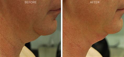 Non Surgical Neck Lift Ny Before After Pictures