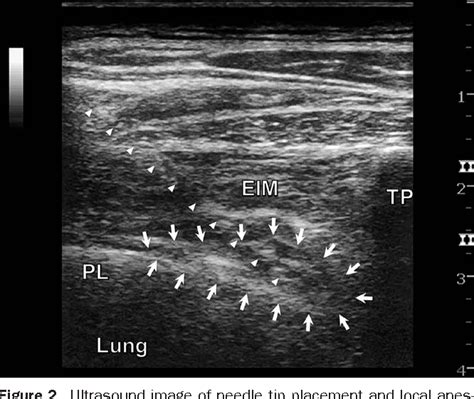 Figure From Case Report Ultrasound Guided Continuous Thoracic