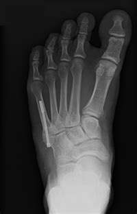 5th Metatarsal Fracture Surgery Procedure & Recovery