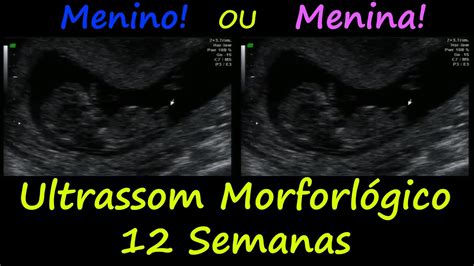 Ultrassom Morfológico 12 Semana Menino Ou Menina Youtube