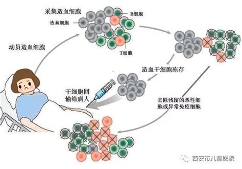 关于自体造血干细胞移植的那些事 搜狐大视野 搜狐新闻