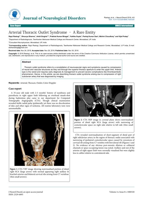 (PDF) Arterial Thoracic Outlet Syndrome – A Rare Entity