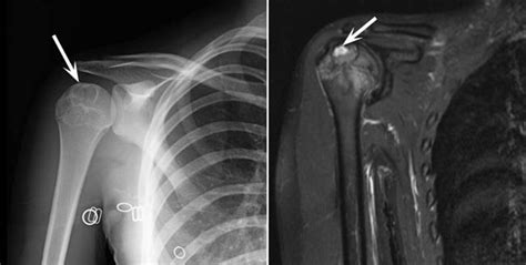 Chondroblastoma Orthoinfo Aaos