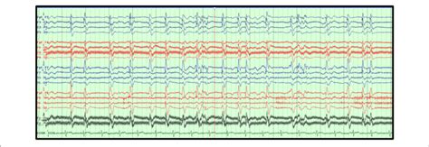 Generalized Periodic Discharges Gpds Gpds At 1 2 Hz Superimposed