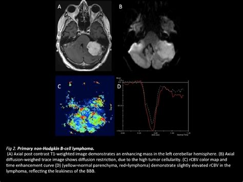 Figure From Dynamic Susceptibility Contrast Enhanced Perfusion Mr