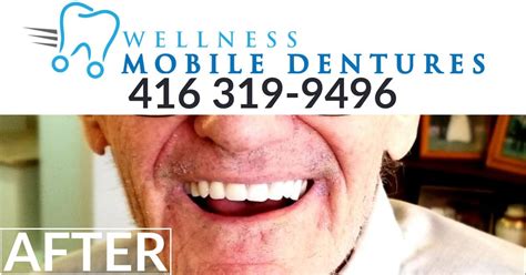 Wellness Mobile Denture Smile Transformation 1 Hour Denture Repair