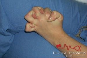 Ehlers-Danlos Syndrome - Physical Diagnosis PDX