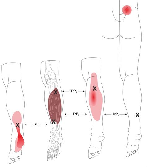 Ankle & Achilles Pain Program | Spine Plus