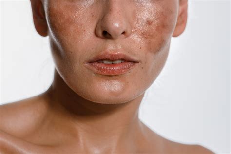 Melasma Removal Austin Laser Solutions