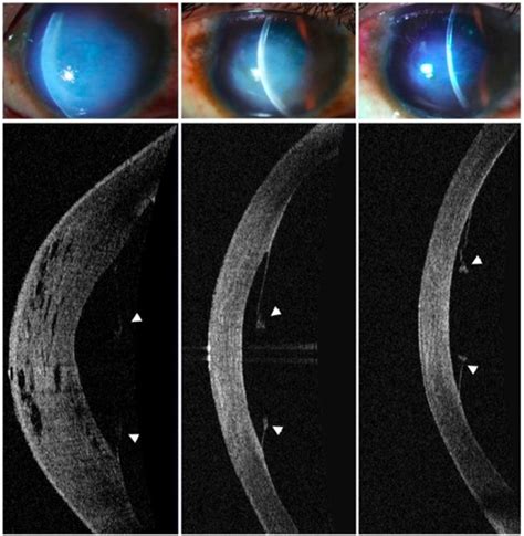 Full Article Keratoconus Current Perspectives