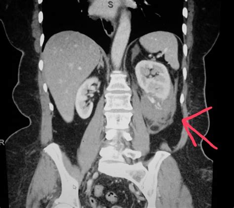 17 Best images about CT Scans on Pinterest | Cars, Gallstone and ... 