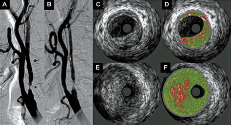 Carotid Plaque Characterization By Virtual Histology Intravascular