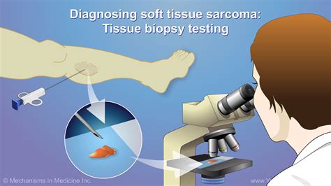 Diagnosing And Treating Soft Tissue Sarcoma