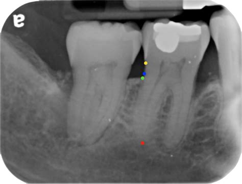 Illustration Of Radiographic Bone Loss How To Calculate The Percentage