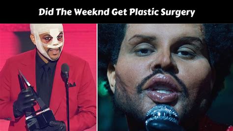 Did The Weeknd Get Plastic Surgery