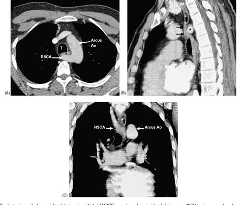 Dysphagia Lusoria Semantic Scholar