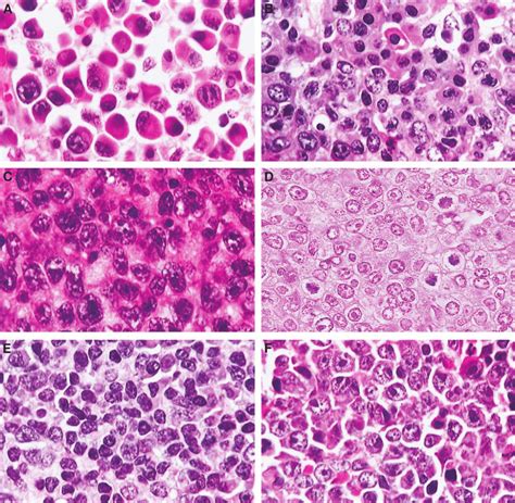 Plasma Cell And T Cell Lymphomas A Plasmacytoma Well Differentiated