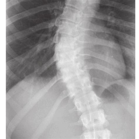 1 X Ray Of A Female Patient With Idiopathic Scoliosis Download Scientific Diagram