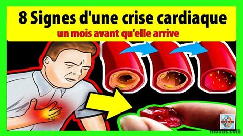 Comment Reconnaître Une Crise Cardiaque Un Mois Avant Quelle Arrive