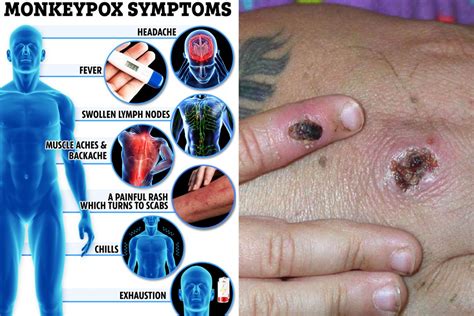 The 8 symptoms of monkeypox you need to know