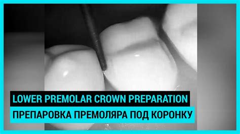 Lower Premolar Crown Preparation Препаровка нижнего премоляра под коронку Youtube