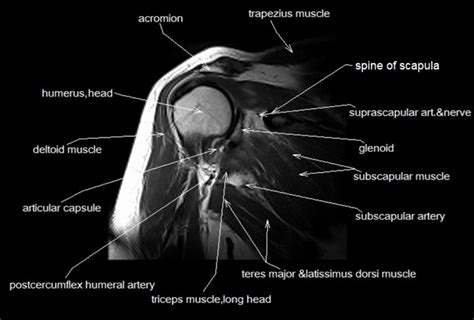 Shoulder Mri Diagram Quizlet