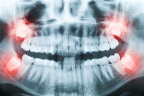 Wisdom Tooth Extraction What To Expect Before During After Surgery