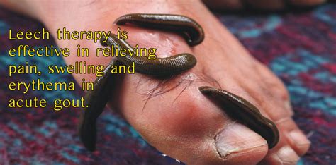 Medicinal Leech Therapy