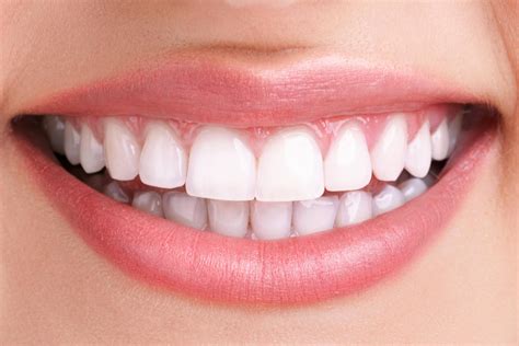 White Fillings Smile Dental Care