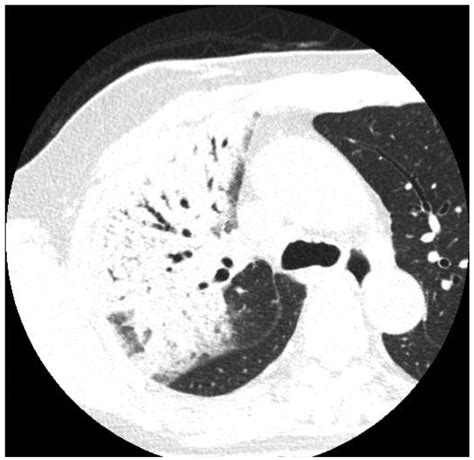 Symptomatic Radiation Pneumonitis After Accelerated Partial Breast