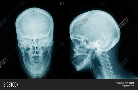 X Ray Skull Ap Lateral Image And Photo Free Trial Bigstock