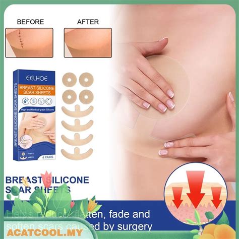 Acatcool My Breast Silicone Scar Sheets Fade Flatten Scar Removal