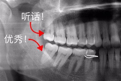 智齿不痛就不用拔吗？看了这篇你就懂了！牙齿