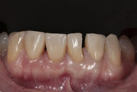 Managing The Matrix In Class Iv Restorations Styleitaliano Org