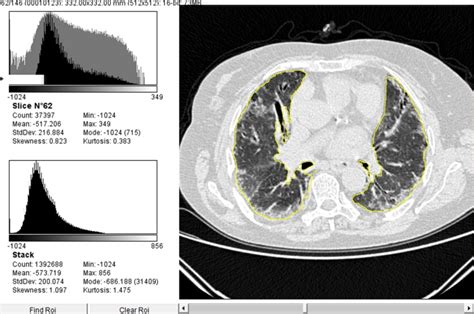 Performance Of A New Quantitative Computed Tomography Index For