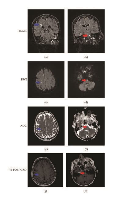 Representative Mri Images Showing Infarcts In The Right Parietal Lobe Download Scientific