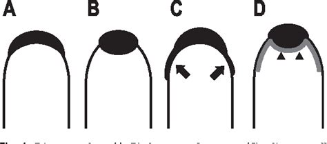 Pdf Focal Thickening At The Fundus Of The Gallbladder Computed