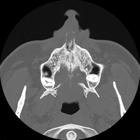 Normal Sinus Ct Annotated Radiopaedia Axial Bone Window