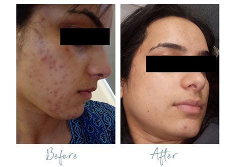 Skinbefore And After Dermal Radiance